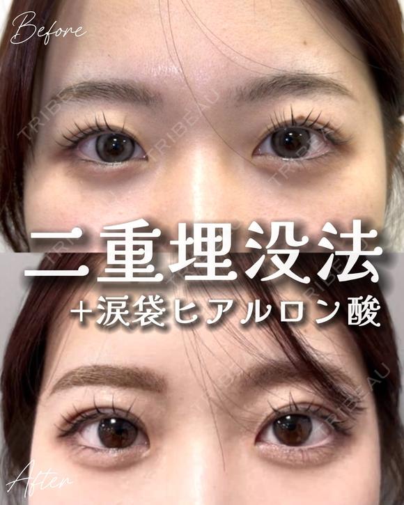 目元くっきり👀二重埋没 before画像 メイン用