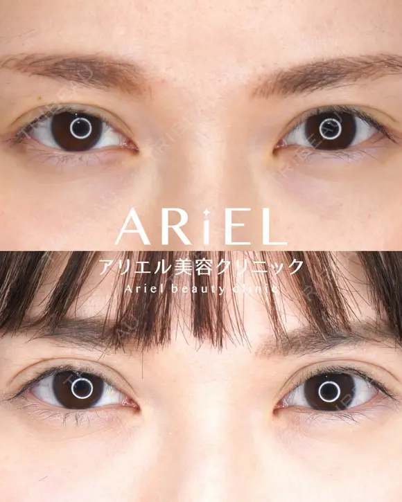 アリエルクイックループ（二重埋没法） before画像 メイン用