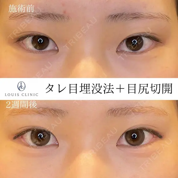 タレ目+目尻切開 before画像 メイン用