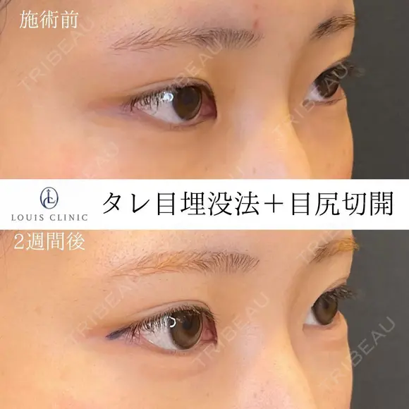 タレ目+目尻切開 14日後 メイン用