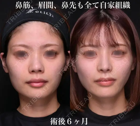 鼻筋、眉間、鼻先も全て自家組織 before画像 メイン用