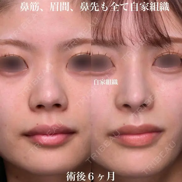 鼻筋、眉間、鼻先も全て自家組織 180日後 メイン用
