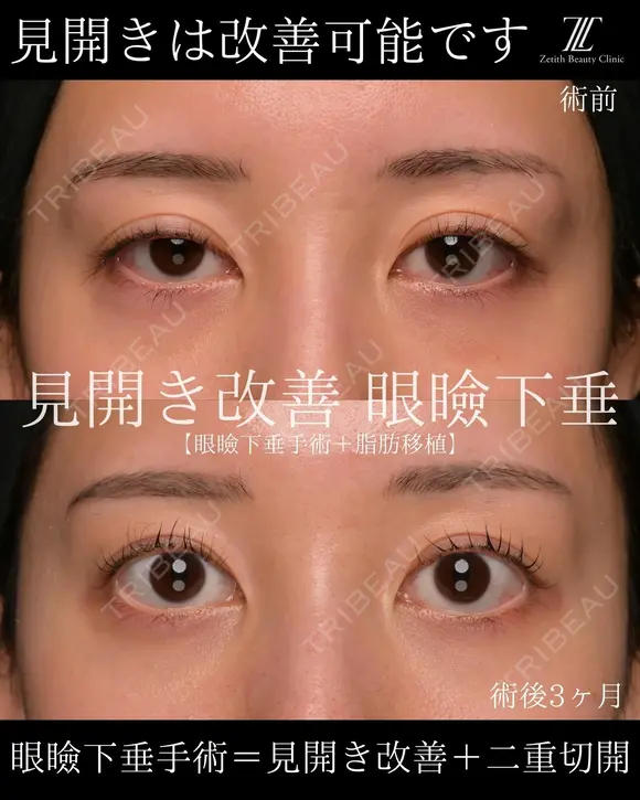 『眼瞼下垂手術は見開きを良くする手術です！』 before画像 メイン用