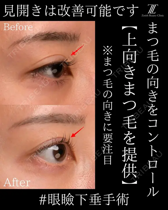 『眼瞼下垂手術は見開きを良くする手術です！』 90日後 メイン用