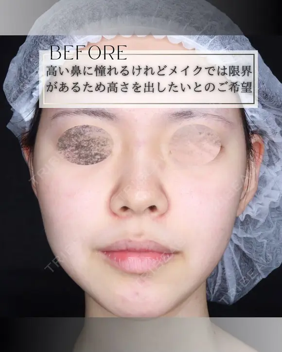鼻プロテーゼ before画像 メイン用
