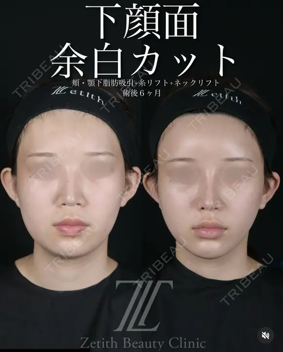 小顔フルコース before画像 メイン用