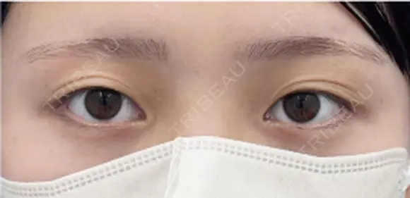 たるみ取り併用全切開二重術 before画像 メイン用