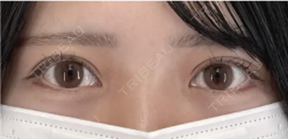 たるみ取り併用全切開二重術 after画像 メイン用