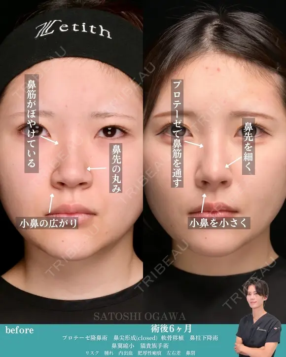 鼻整形　クローズ法の症例です。 after画像 メイン用