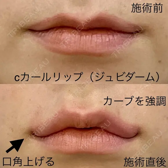Cカールリップ（ジュビダーム） before画像 メイン用