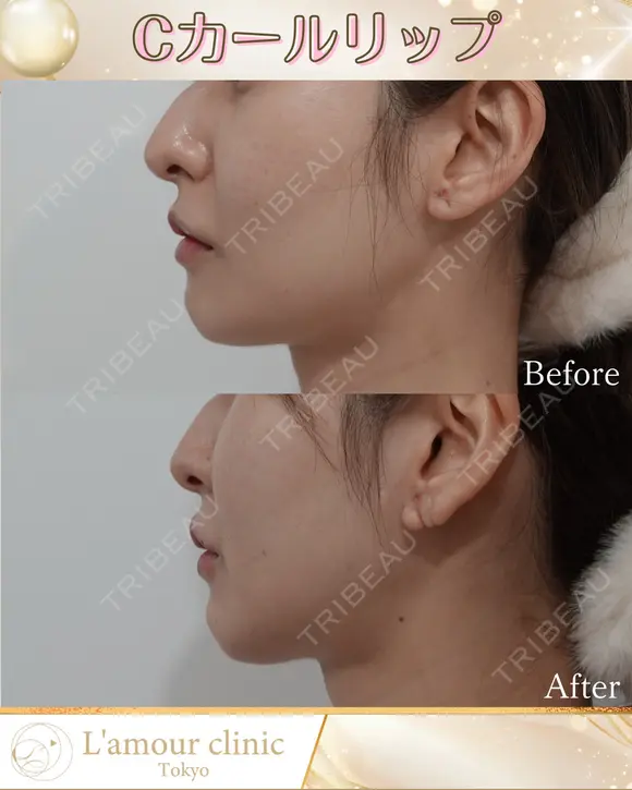 Cカールリップ before画像 メイン用