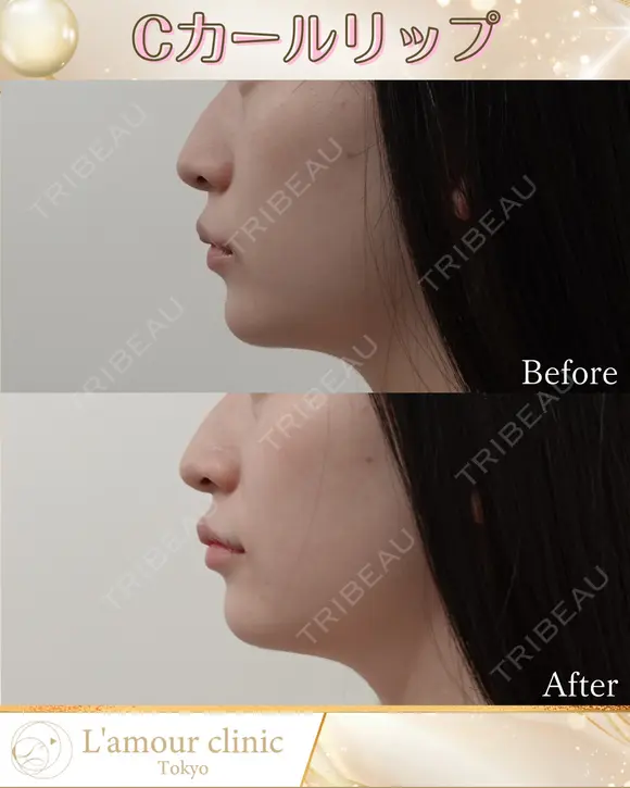 Cカールリップ before画像 メイン用