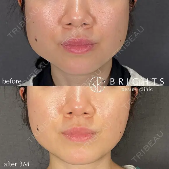 韓国製ボツリヌストキシン　エラ before画像 メイン用