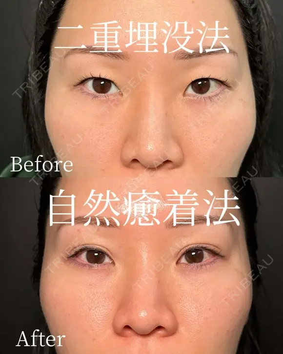 二重埋没(自然癒着法) after画像 メイン用