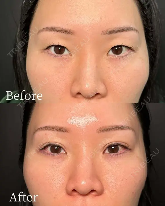 二重埋没(自然癒着法) before画像 メイン用