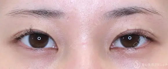 【20代女性・目頭側の重さ解消】目上切開（1ヶ月後） before画像 メイン用