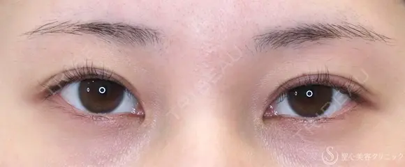 【20代女性・目頭側の重さ解消】目上切開（1ヶ月後） 30日後 メイン用