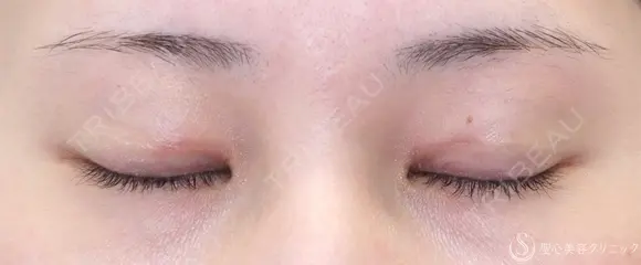 【20代女性・目頭側の重さ解消】目上切開（1ヶ月後） 30日後 メイン用