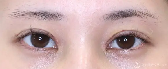 【20代女性・目頭側の重さ解消】目上切開（1ヶ月後） 7日後 メイン用