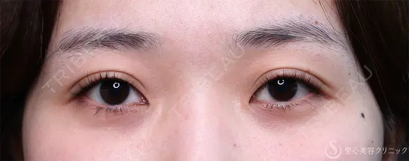 【20代女性・眠そうな目元】眼瞼下垂埋没法（直後・2ヶ月後） before画像 メイン用