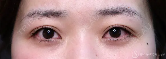 【20代女性・眠そうな目元】眼瞼下垂埋没法（直後・2ヶ月後） 0日後 メイン用
