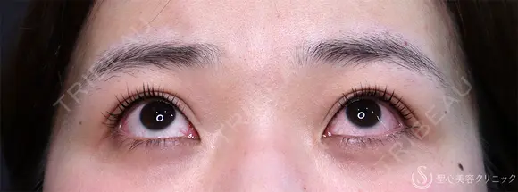 【20代女性・眠そうな目元】眼瞼下垂埋没法（直後・2ヶ月後） 0日後 メイン用