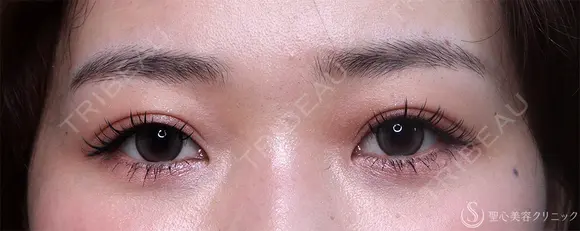 【20代女性・眠そうな目元】眼瞼下垂埋没法（直後・2ヶ月後） 60日後 メイン用