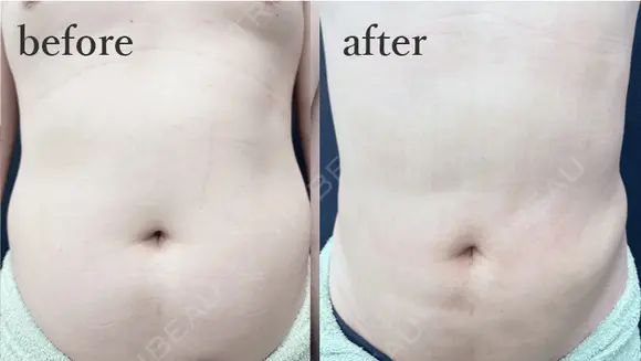 腹部脂肪吸引 after画像 メイン用