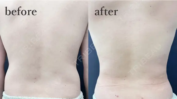 腰部脂肪吸引 before画像 メイン用