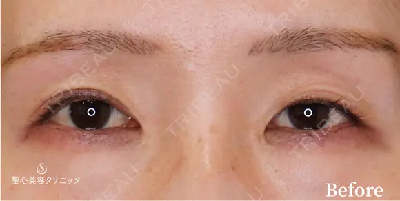 【30代女性・左右のバランスを整える】二重切開法（6ヶ月後） before画像 メイン用