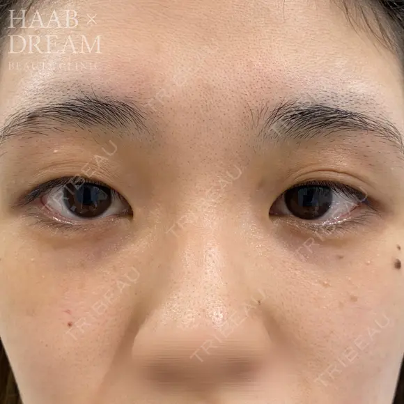 ドリームダブル・目頭切開 before画像 メイン用