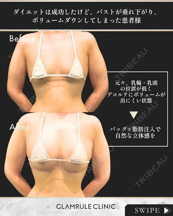 ハイブリッド豊胸 30日後 メイン用