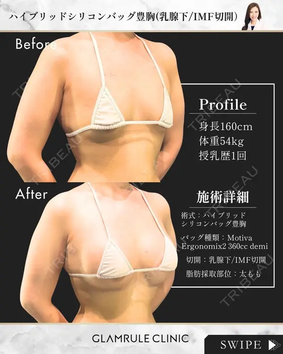 ハイブリッド豊胸 30日後 メイン用