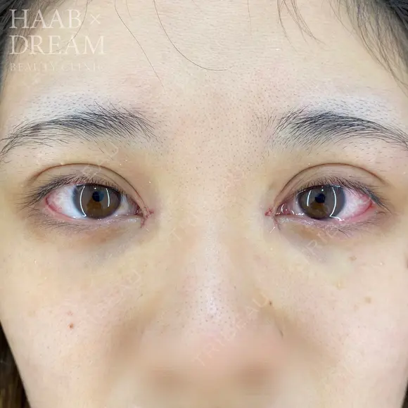 ドリームダブル・目頭切開 after画像 メイン用