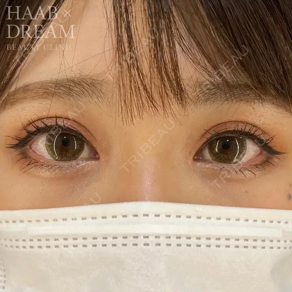 ドリームダブル・目頭切開 30日後 メイン用