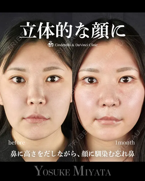 立体的な顔に 30日後 メイン用