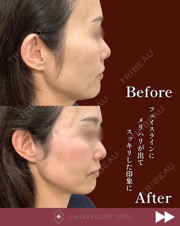 スレッド（糸）リフト before画像 メイン用