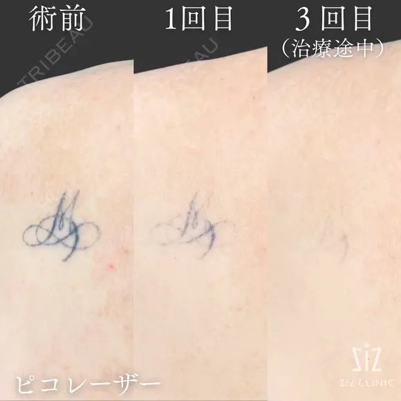【タトゥー除去】仕事で気を遣う… before画像 メイン用