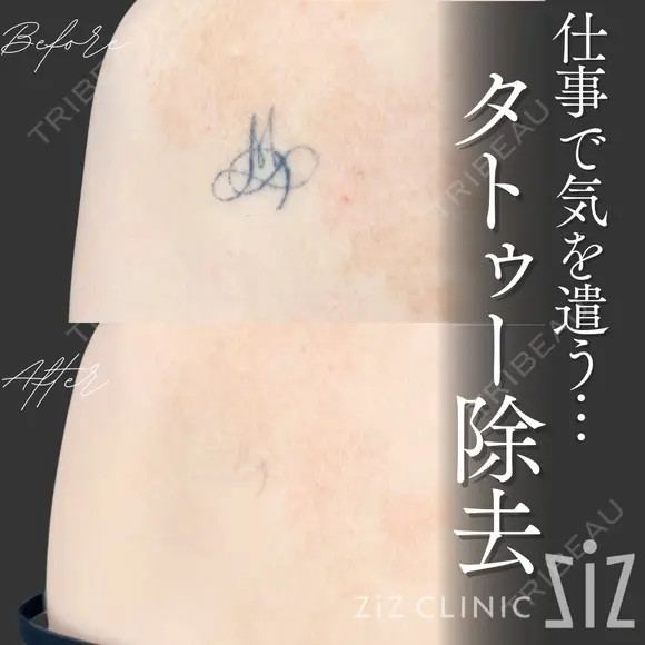 【タトゥー除去】仕事で気を遣う… after画像 メイン用