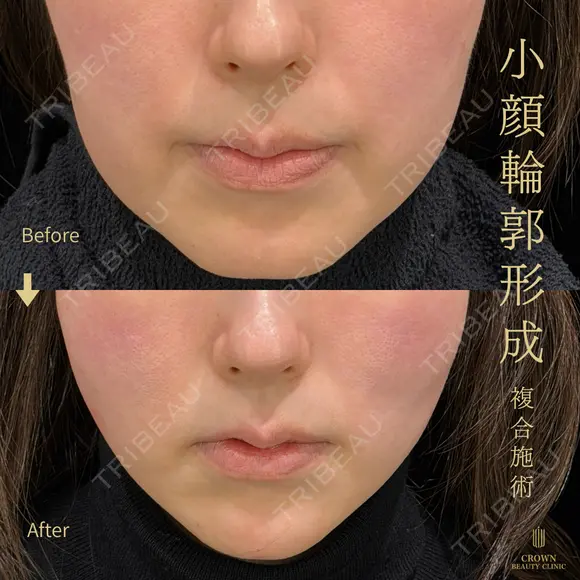 糸リフト・頬ヒアルロン酸・インモードForma両頬＋顎下 after画像 メイン用