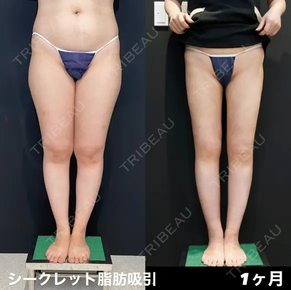 シークレット脂肪吸引脚フル before画像 メイン用