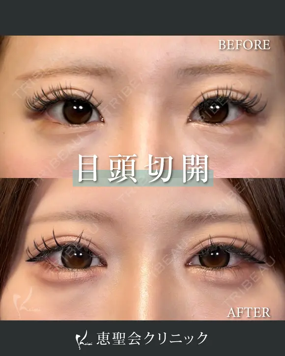 目頭切開 before画像 メイン用