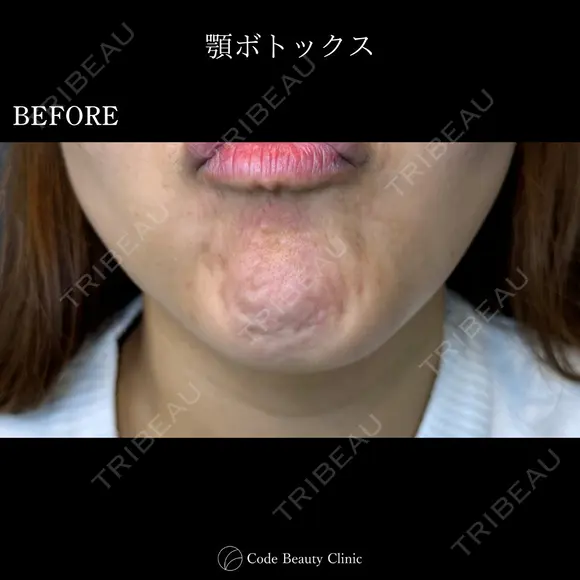 顎ボトックス🌷シワ取りボツリヌストキシン注射 before画像 メイン用