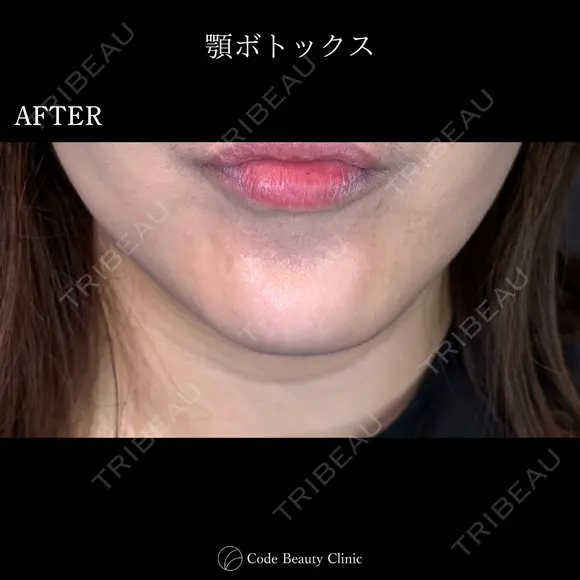 顎ボトックス🌷シワ取りボツリヌストキシン注射 7日後 メイン用