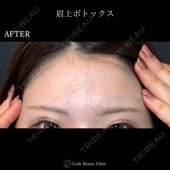 眉上ボトックス🌷シワ取りボツリヌストキシン注射 7日後 メイン用