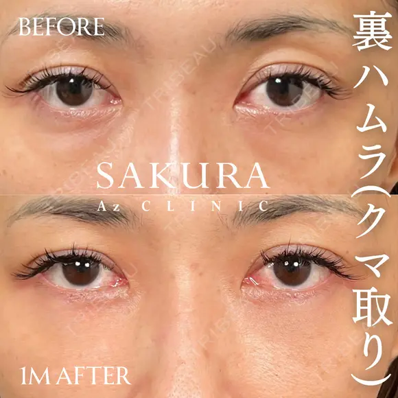 クマ取り(裏ハムラ法) before画像 メイン用