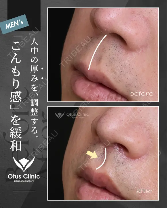 人中短縮(鼻柱切開) ・ 鼻翼縮小 ・ 鼻翼挙上 90日後 メイン用