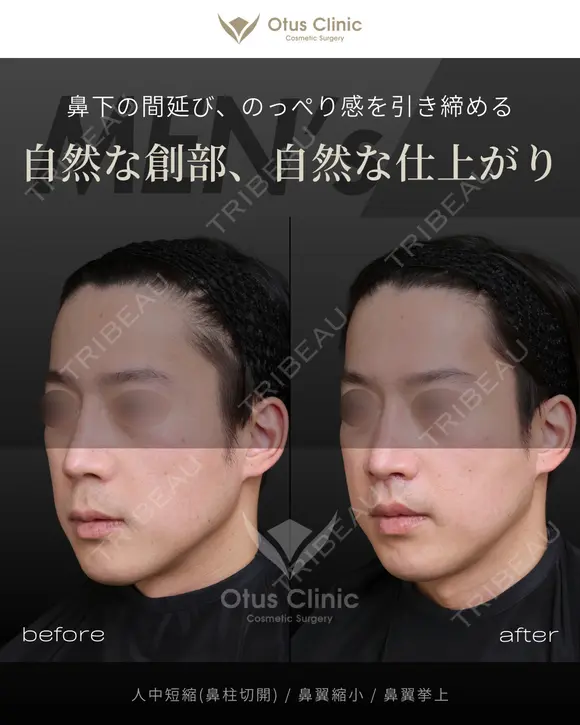 人中短縮(鼻柱切開) ・ 鼻翼縮小 ・ 鼻翼挙上 before画像 メイン用