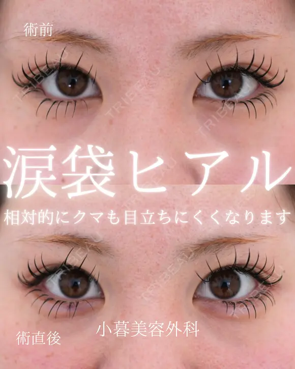 涙袋ヒアルロン酸 before画像 メイン用