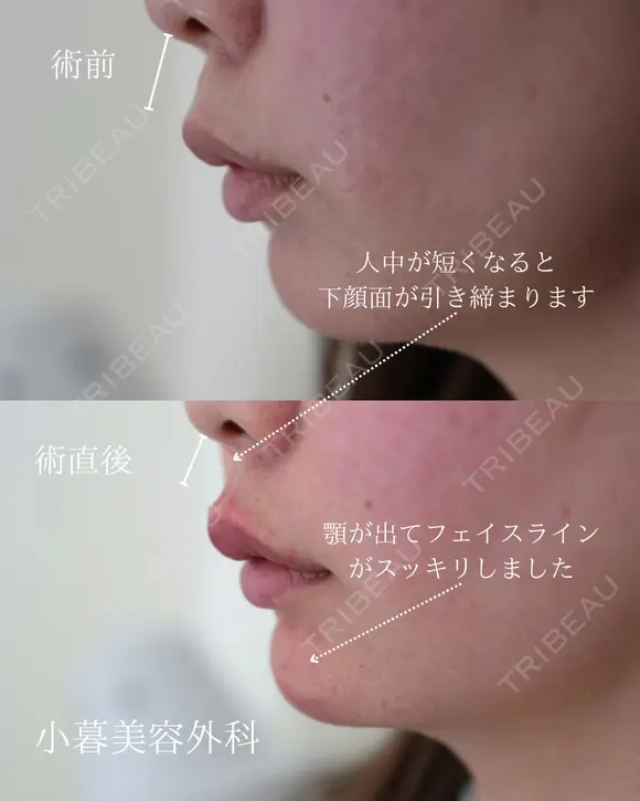 唇ヒアルロン酸　顎ヒアルロン酸 before画像 メイン用